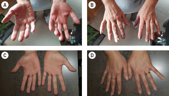 testimonials-psoriasis_case_2-all-(1).jpg
