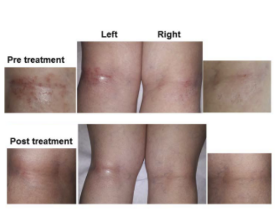 Treatment of non-atopic dermatitis with polarized UV-free polychromatic light: A case report - Bioptron Doctor's Corner photo