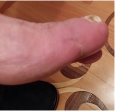 Diabetic Foot - Testimonial photo