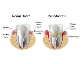 Use of Photobiomodulation Induced by Polarized Polychromatic Non-Coherent Light in The Management of Adult Chronic Periodontitis - Bioptron Doctor's Corner photo