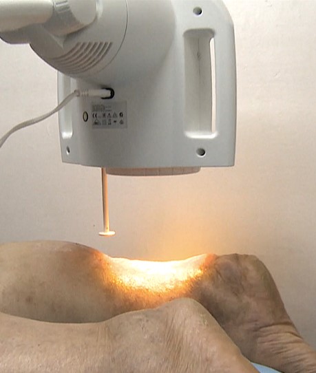 Bioptron Hyperlight Therapy in the treatment of diabetic foot ulcer - Bioptron News photo