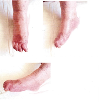 Chronic Disease, Diabetic Foot - Testimonial photo