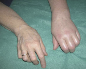 Complex Regional Pain Syndrome (Sudeck Atrophy) Prevention Possibility and Accelerated Recovery in Patients with Distal Radius at the Typical Site Fracture Using Polarized, Polychromatic Light Therapy - Bioptron Doctor's Corner photo