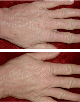 Atopic Dermatitis - Testimonial photo